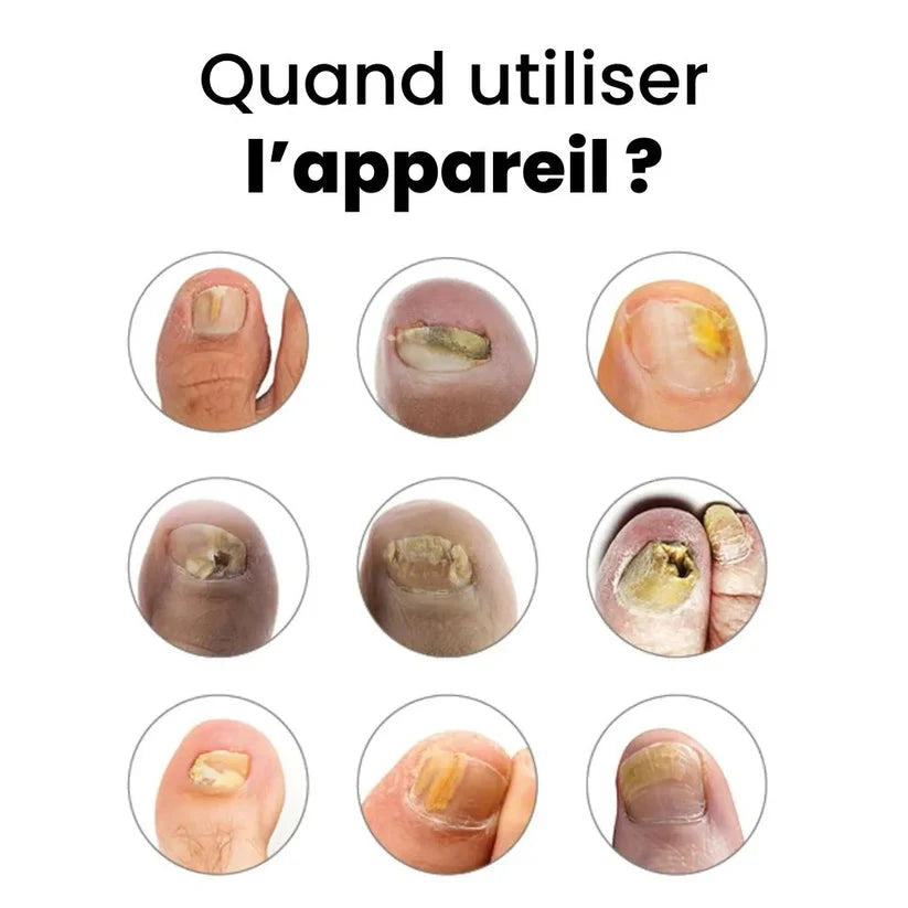 Appareil de traitement des mycoses Astra Novah